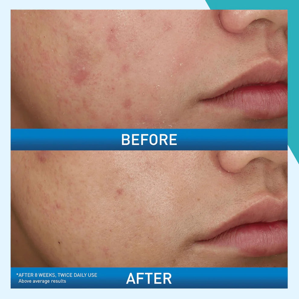 Acne Control Foaming Cream Face Wash CeraVe 150ML